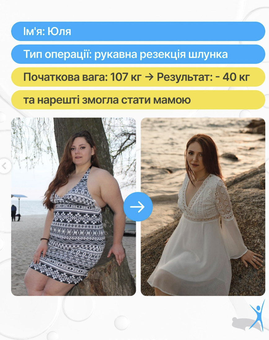Пацієнтка Юлія до та після рукавної резекції шлунка: результат мінус 40 кілограмів