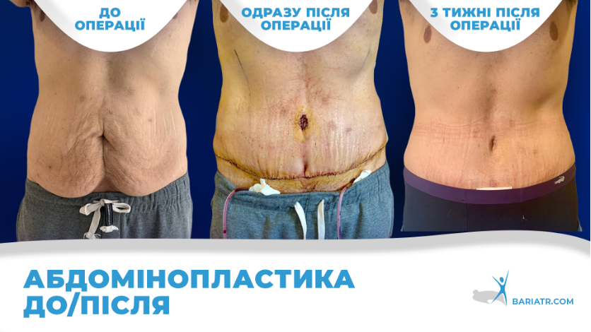 ефективність абдомінопластики: до та після