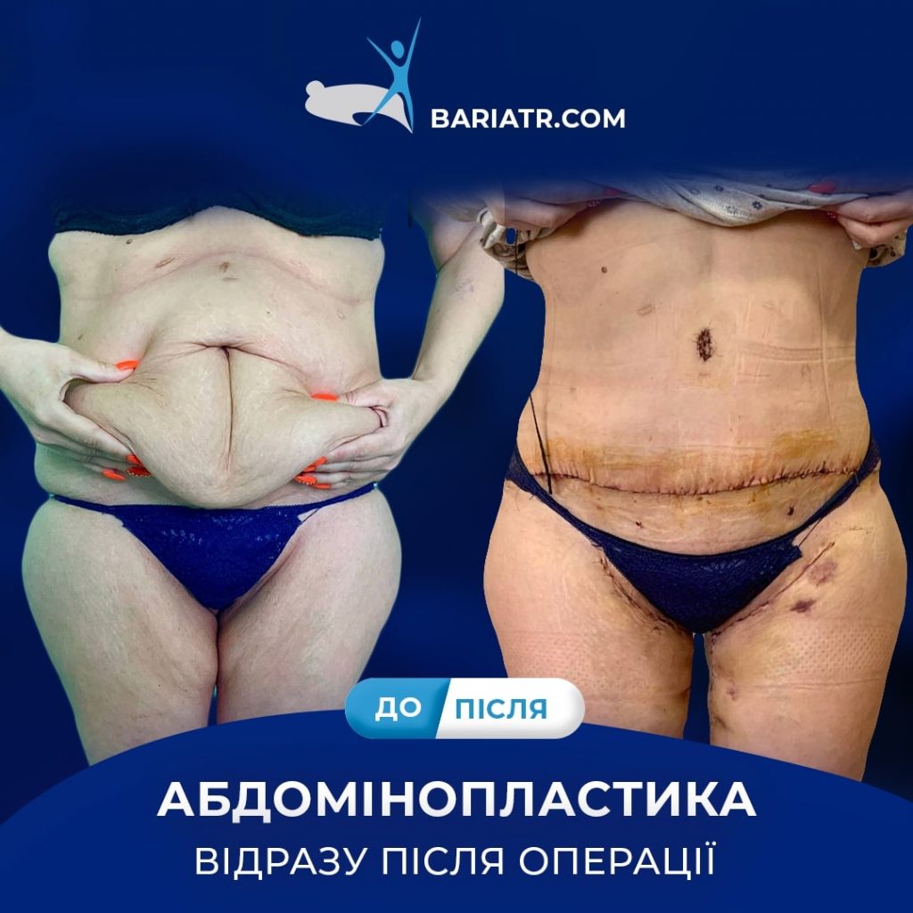 хірургічне втручання для корекції фігури в Києві