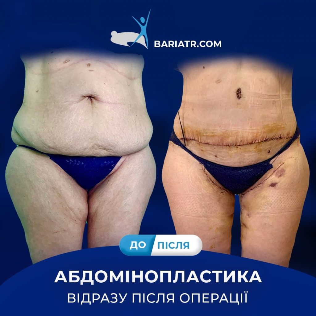 абдомінопластика: корекція фігури в Центрі метаболічної хірургії