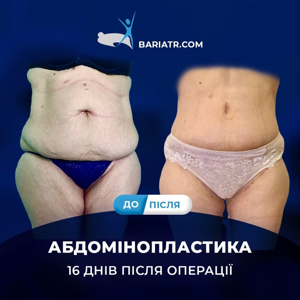 абдомінопластика: Центр метаболічної хірургії