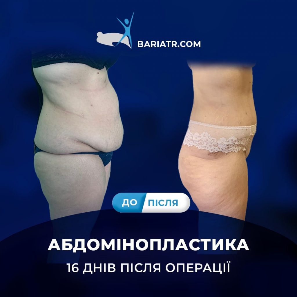 абдомінопластика у виконанні Андріана Рейті, баріатричного хірурга