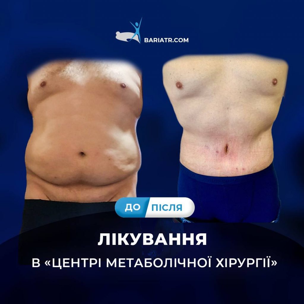 ефективність абдомінопластики, виконаної Андріаном Рейті